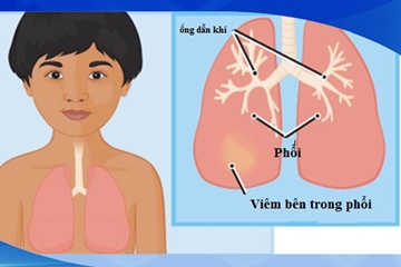 Cách phòng tránh bệnh viêm phổi ở trẻ nhỏ trong thời tiết giao mùa