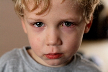 Trẻ nhỏ bị quầng thâm ở mắt cảnh báo bệnh gì? các bậc cha mẹ nên cần biết