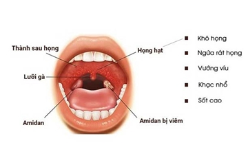 Viêm họng là gì, nguyên nhân cách điều trị từ thảo dược